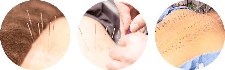 ルート治療で改善