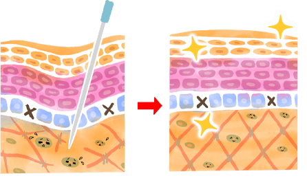 鍼によるコリ改善のメカニズム